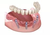 Advanced Dental Implants Institute image 1